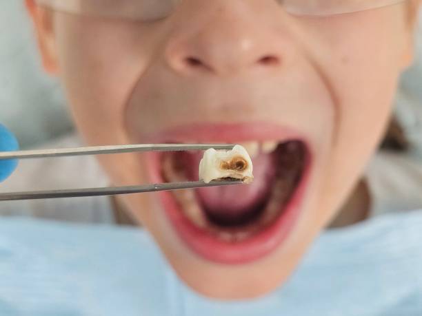 Best Emergency Tooth Extraction in Sunset Hills, MO